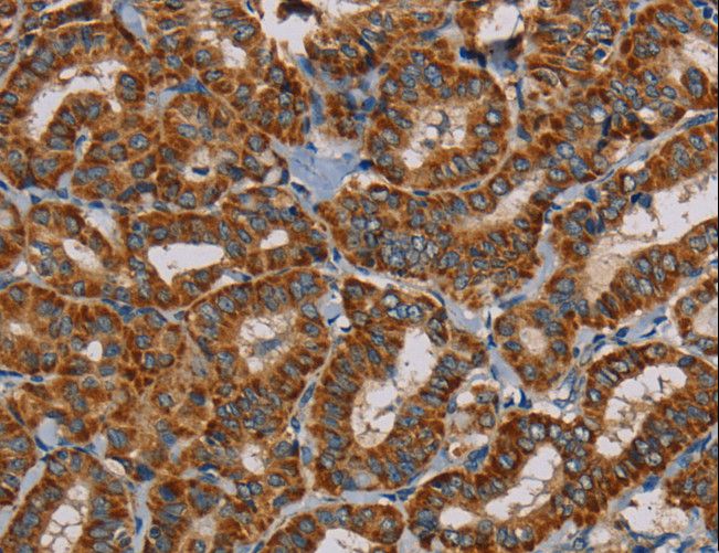 MRPL28 Antibody - Immunohistochemistry of paraffin-embedded Human thyroid cancer using MRPL28 Polyclonal Antibody at dilution of 1:45.