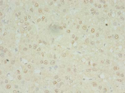 MRPL3 Antibody - Immunohistochemistry of paraffin-embedded human liver cancer using antibody at dilution of 1:100.