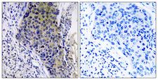 MRPL34 Antibody - Peptide - + Immunohistochemistry analysis of paraffin-embedded human lung carcinoma tissue using RM34 antibody.