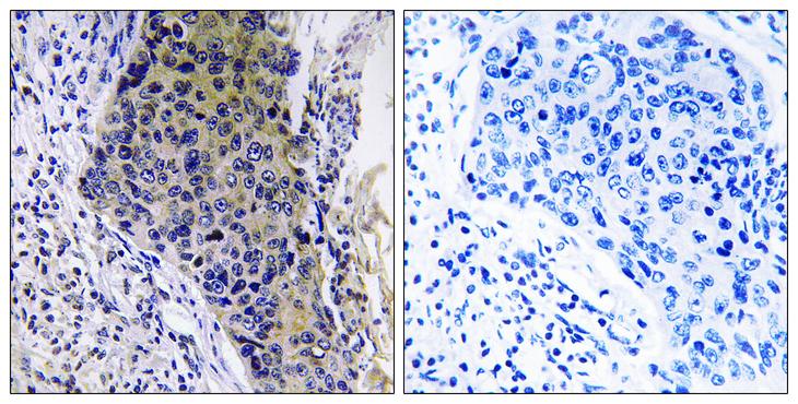 MRPL34 Antibody - Peptide - + Immunohistochemistry analysis of paraffin-embedded human lung carcinoma tissue using RM34 antibody.