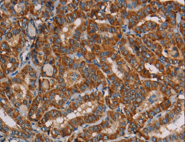 MRPL39 Antibody - Immunohistochemistry of paraffin-embedded Human thyroid cancer using MRPL39 Polyclonal Antibody at dilution of 1:45.