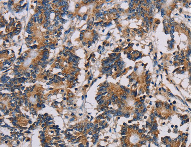 MRPL39 Antibody - Immunohistochemistry of paraffin-embedded Human colon cancer using MRPL39 Polyclonal Antibody at dilution of 1:30.
