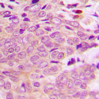 MRPL40 Antibody - Immunohistochemical analysis of MRPL40 staining in human breast cancer formalin fixed paraffin embedded tissue section. The section was pre-treated using heat mediated antigen retrieval with sodium citrate buffer (pH 6.0). The section was then incubated with the antibody at room temperature and detected using an HRP conjugated compact polymer system. DAB was used as the chromogen. The section was then counterstained with hematoxylin and mounted with DPX.