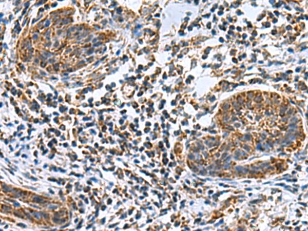 MRPL40 Antibody - Immunohistochemistry of paraffin-embedded Human esophagus cancer tissue  using MRPL40 Polyclonal Antibody at dilution of 1:80(×200)