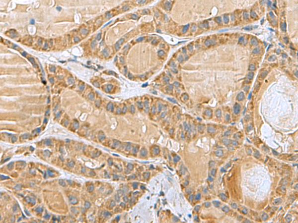 MRPL40 Antibody - Immunohistochemistry of paraffin-embedded Human thyroid cancer tissue  using MRPL40 Polyclonal Antibody at dilution of 1:80(×200)