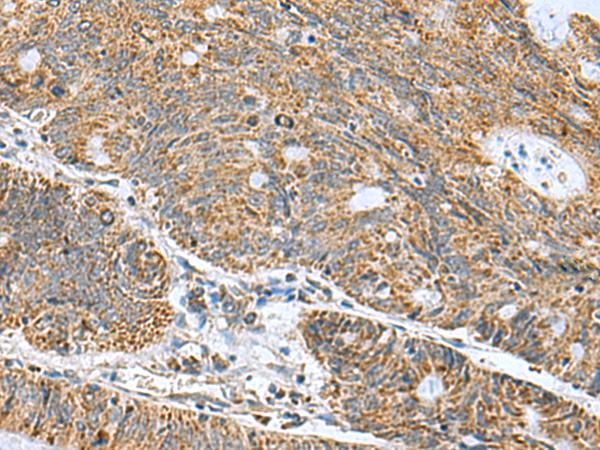 MRPL40 Antibody - Immunohistochemistry of paraffin-embedded Human colorectal cancer tissue  using MRPL40 Polyclonal Antibody at dilution of 1:50(×200)