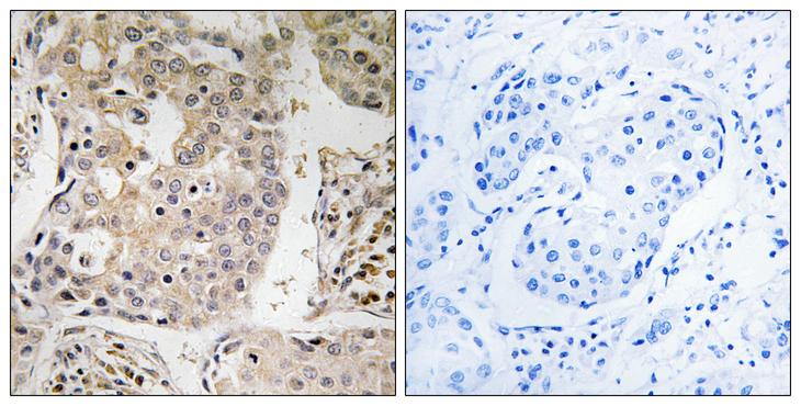 MRPL41 / PIG3 / BMRP Antibody - Peptide - + Immunohistochemistry analysis of paraffin-embedded human breast carcinoma tissue, using MRPL41 antibody.