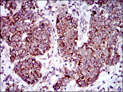 MRPL42 / MRPS32 Antibody - IHC of paraffin-embedded breast cancer tissues using MRPL42 mouse monoclonal antibody with DAB staining.
