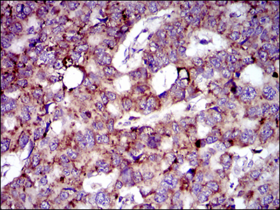 MRPL42 / MRPS32 Antibody - IHC of paraffin-embedded esophageal cancer tissues using MRPL42 mouse monoclonal antibody with DAB staining.