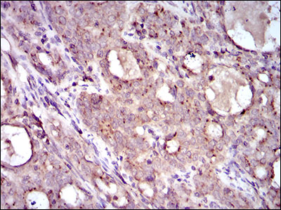MRPL42 / MRPS32 Antibody - IHC of paraffin-embedded cervical cancer tissues using MRPL42 mouse monoclonal antibody with DAB staining.
