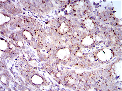 MRPL42 / MRPS32 Antibody - IHC of paraffin-embedded cervical cancer tissues using MRPL42 mouse monoclonal antibody with DAB staining.