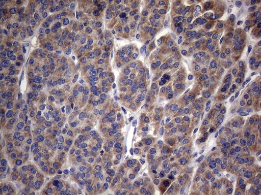 MRPL42 / MRPS32 Antibody - Immunohistochemical staining of paraffin-embedded Carcinoma of Human thyroid tissue using anti-MRPL42 mouse monoclonal antibody. (Heat-induced epitope retrieval by 1mM EDTA in 10mM Tris buffer. (pH8.5) at 120°C for 3 min. (1:150)