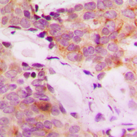 MRPL42 / MRPS32 Antibody - Immunohistochemical analysis of MRPS32 staining in human breast cancer formalin fixed paraffin embedded tissue section. The section was pre-treated using heat mediated antigen retrieval with sodium citrate buffer (pH 6.0). The section was then incubated with the antibody at room temperature and detected using an HRP conjugated compact polymer system. DAB was used as the chromogen. The section was then counterstained with hematoxylin and mounted with DPX.