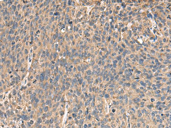 MRPL42 / MRPS32 Antibody - Immunohistochemistry of paraffin-embedded Human cervical cancer tissue  using MRPL42 Polyclonal Antibody at dilution of 1:65(×200)