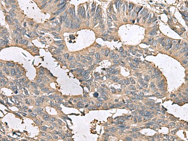 MRPL42 / MRPS32 Antibody - Immunohistochemistry of paraffin-embedded Human colorectal cancer tissue  using MRPL42 Polyclonal Antibody at dilution of 1:65(×200)