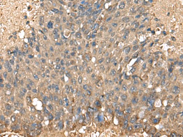 MRPL42 / MRPS32 Antibody - Immunohistochemistry of paraffin-embedded Human liver cancer tissue  using MRPL42 Polyclonal Antibody at dilution of 1:60(×200)