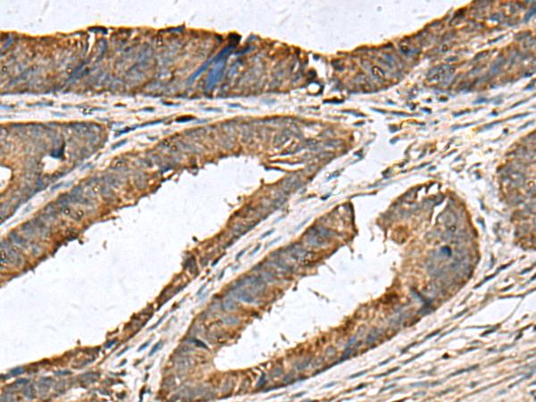 MRPL42 / MRPS32 Antibody - Immunohistochemistry of paraffin-embedded Human colorectal cancer tissue  using MRPL42 Polyclonal Antibody at dilution of 1:60(×200)