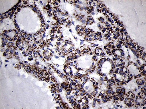 MRPL44 Antibody - Immunohistochemical staining of paraffin-embedded Carcinoma of Human thyroid tissue using anti-MRPL44 mouse monoclonal antibody. (Heat-induced epitope retrieval by 1mM EDTA in 10mM Tris buffer. (pH8.5) at 120°C for 3 min. (1:500)