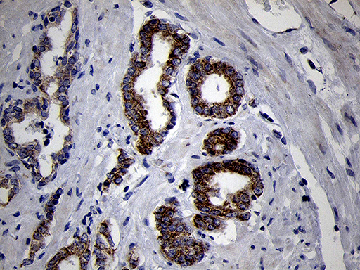 MRPL44 Antibody - Immunohistochemical staining of paraffin-embedded Carcinoma of Human prostate tissue using anti-MRPL44 mouse monoclonal antibody. (Heat-induced epitope retrieval by 1mM EDTA in 10mM Tris buffer. (pH8.5) at 120°C for 3 min. (1:500)