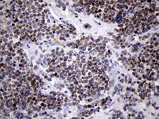 MRPL44 Antibody - Immunohistochemical staining of paraffin-embedded Human lymphoma tissue using anti-MRPL44 mouse monoclonal antibody. (Heat-induced epitope retrieval by 1mM EDTA in 10mM Tris buffer. (pH8.5) at 120°C for 3 min. (1:500)