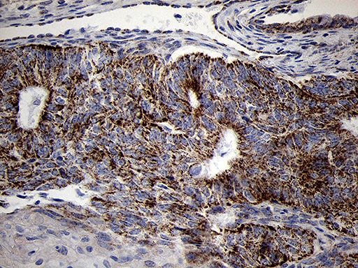 MRPL44 Antibody - Immunohistochemical staining of paraffin-embedded Adenocarcinoma of Human endometrium tissue using anti-MRPL44 mouse monoclonal antibody. (Heat-induced epitope retrieval by 1mM EDTA in 10mM Tris buffer. (pH8.5) at 120°C for 3 min. (1:500)