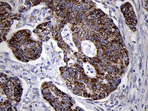MRPL44 Antibody - Immunohistochemical staining of paraffin-embedded Adenocarcinoma of Human colon tissue using anti-MRPL44 mouse monoclonal antibody. (Heat-induced epitope retrieval by 1mM EDTA in 10mM Tris buffer. (pH8.5) at 120°C for 3 min. (1:500)