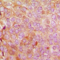 MRPL48 Antibody - Immunohistochemical analysis of MRPL48 staining in human breast cancer formalin fixed paraffin embedded tissue section. The section was pre-treated using heat mediated antigen retrieval with sodium citrate buffer (pH 6.0). The section was then incubated with the antibody at room temperature and detected with HRP and DAB as chromogen. The section was then counterstained with hematoxylin and mounted with DPX.