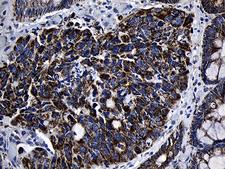 MRPL48 Antibody - Immunohistochemical staining of paraffin-embedded Adenocarcinoma of Human colon tissue using anti-MRPL48 mouse monoclonal antibody. (Heat-induced epitope retrieval by 1mM EDTA in 10mM Tris buffer. (pH8.5) at 120°C for 3 min. (1:500)