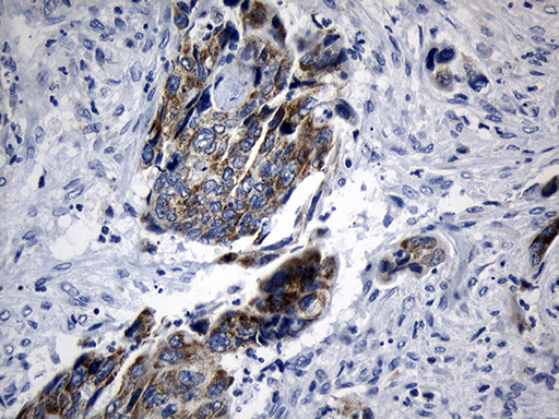 MRPL48 Antibody - Immunohistochemical staining of paraffin-embedded Adenocarcinoma of Human colon tissue using anti-MRPL48 mouse monoclonal antibody. (Heat-induced epitope retrieval by 1mM EDTA in 10mM Tris buffer. (pH8.5) at 120°C for 3 min. (1:150)