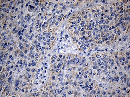 MRPL48 Antibody - Immunohistochemical staining of paraffin-embedded Carcinoma of Human lung tissue using anti-MRPL48 mouse monoclonal antibody. (Heat-induced epitope retrieval by 1mM EDTA in 10mM Tris buffer. (pH8.5) at 120°C for 3 min. (1:150)