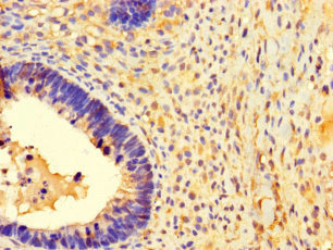 MRPL50 Antibody - Immunohistochemistry of paraffin-embedded human ovarian cancer using MRPL50 Antibody at dilution of 1:100