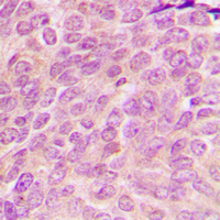 MRPL54 Antibody - Immunohistochemical analysis of MRPL54 staining in human breast cancer formalin fixed paraffin embedded tissue section. The section was pre-treated using heat mediated antigen retrieval with sodium citrate buffer (pH 6.0). The section was then incubated with the antibody at room temperature and detected using an HRP conjugated compact polymer system. DAB was used as the chromogen. The section was then counterstained with hematoxylin and mounted with DPX.