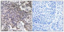 MRPL54 Antibody - Peptide - + Immunohistochemistry analysis of paraffin-embedded human lung carcinoma tissue using MRPL54 antibody.