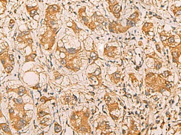 MRPL9 Antibody - Immunohistochemistry of paraffin-embedded Human liver cancer tissue  using MRPL9 Polyclonal Antibody at dilution of 1:55(×200)