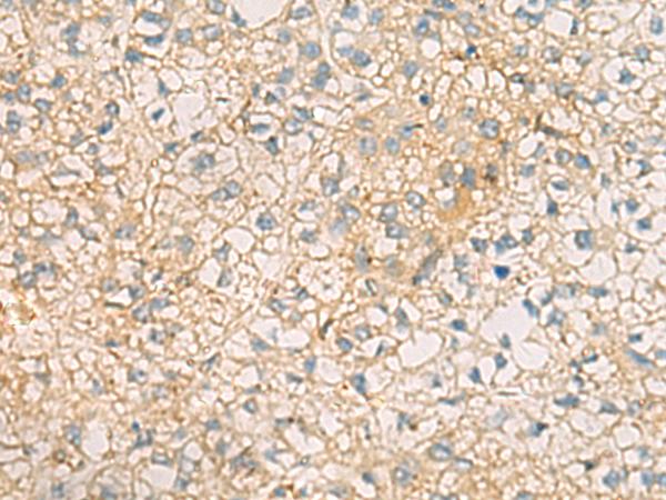 MRPL9 Antibody - Immunohistochemistry of paraffin-embedded Human liver cancer tissue  using MRPL9 Polyclonal Antibody at dilution of 1:60(×200)
