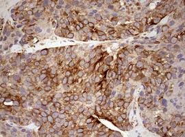 MRPS11 Antibody - IHC of paraffin-embedded Adenocarcinoma of Human breast tissue using anti-MRPS11 mouse monoclonal antibody. (Heat-induced epitope retrieval by 10mM citric buffer, pH6.0, 120°C for 3min).