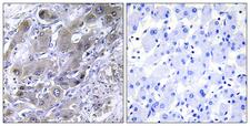 MRPS18A Antibody - Peptide - + Immunohistochemistry analysis of paraffin-embedded human liver carcinoma tissue using MRPS18A antibody.