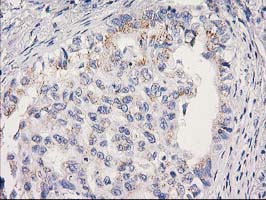 MRPS2 Antibody - IHC of paraffin-embedded Carcinoma of Human lung tissue using anti-MRPS2 mouse monoclonal antibody.