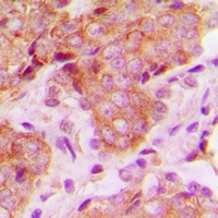 MRPS22 Antibody - Immunohistochemical analysis of MRPS22 staining in human breast cancer formalin fixed paraffin embedded tissue section. The section was pre-treated using heat mediated antigen retrieval with sodium citrate buffer (pH 6.0). The section was then incubated with the antibody at room temperature and detected with HRP and DAB as chromogen. The section was then counterstained with hematoxylin and mounted with DPX.