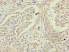 MRPS22 Antibody - Immunohistochemistry of paraffin-embedded human lung cancer at dilution of 1:100