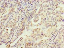 MRPS22 Antibody - Immunohistochemistry of paraffin-embedded human lung cancer at dilution of 1:100
