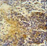 MRPS24 Antibody - MRPS24 antibody immunohistochemistry of formalin-fixed and paraffin-embedded human lung carcinoma followed by peroxidase-conjugated secondary antibody and DAB staining.