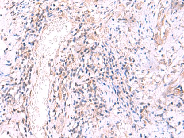 MRPS24 Antibody - Immunohistochemistry of paraffin-embedded Human cervical cancer tissue  using MRPS24 Polyclonal Antibody at dilution of 1:90(×200)