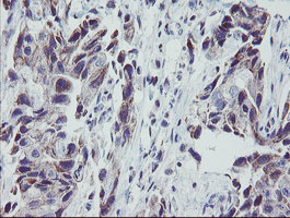 MRPS27 Antibody - IHC of paraffin-embedded Adenocarcinoma of Human breast tissue using anti-MRPS27 mouse monoclonal antibody. (Heat-induced epitope retrieval by 10mM citric buffer, pH6.0, 100C for 10min).