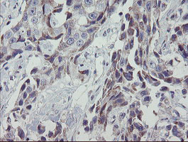 MRPS27 Antibody - IHC of paraffin-embedded Adenocarcinoma of Human breast tissue using anti-MRPS27 mouse monoclonal antibody.