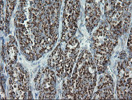 MRPS27 Antibody - IHC of paraffin-embedded Carcinoma of Human thyroid tissue using anti-MRPS27 mouse monoclonal antibody.