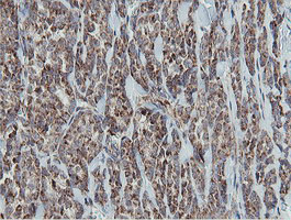 MRPS27 Antibody - IHC of paraffin-embedded Carcinoma of Human thyroid tissue using anti-MRPS27 mouse monoclonal antibody.