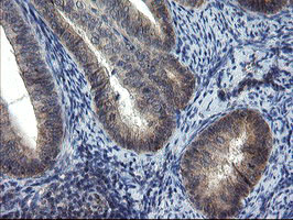 MRPS27 Antibody - IHC of paraffin-embedded Adenocarcinoma of Human endometrium tissue using anti-MRPS27 mouse monoclonal antibody.