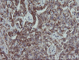 MRPS27 Antibody - IHC of paraffin-embedded Carcinoma of Human kidney tissue using anti-MRPS27 mouse monoclonal antibody.