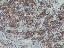 MRPS27 Antibody - IHC of paraffin-embedded Carcinoma of Human liver tissue using anti-MRPS27 mouse monoclonal antibody.